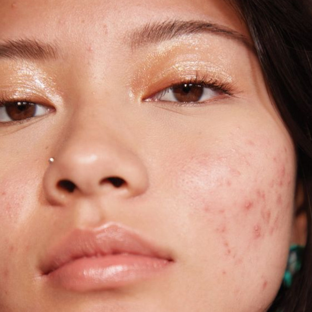 Understanding Types of Acne and their Effective Treatment